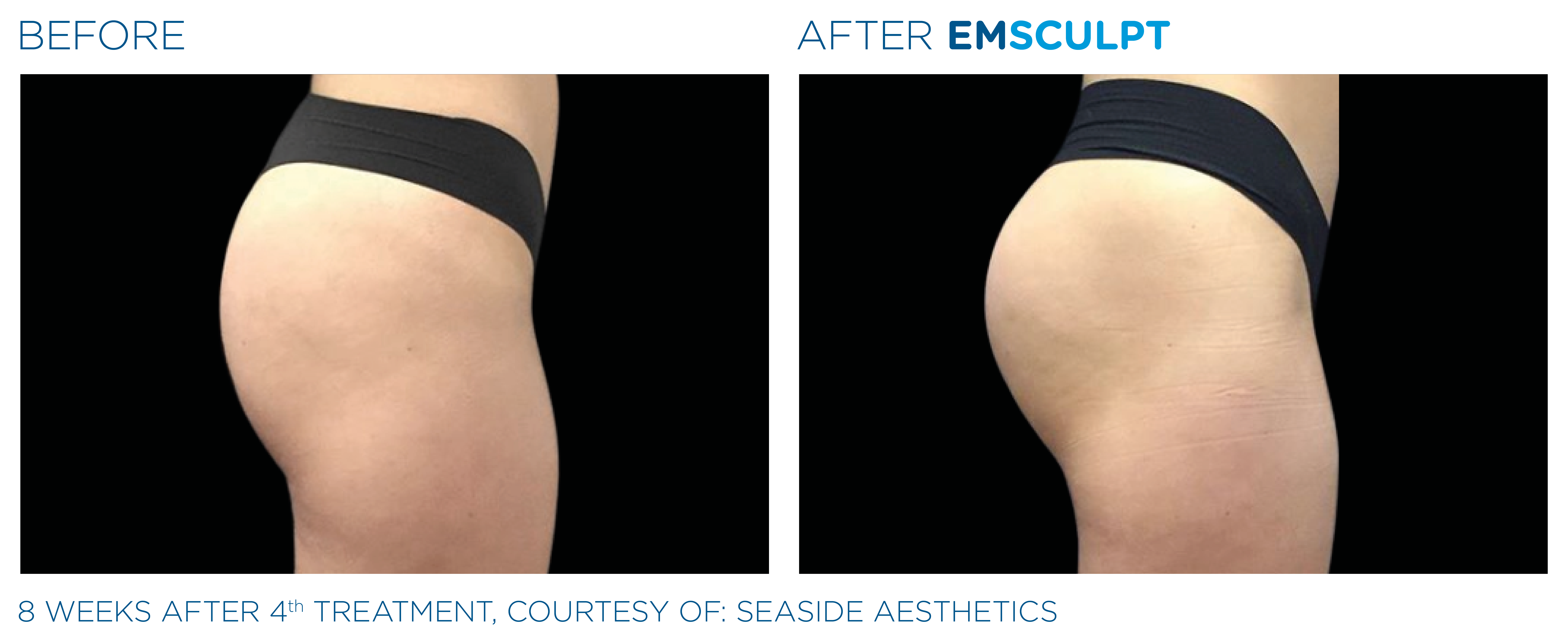 Emsculpt before and after bu ttocks— medAge Asheville