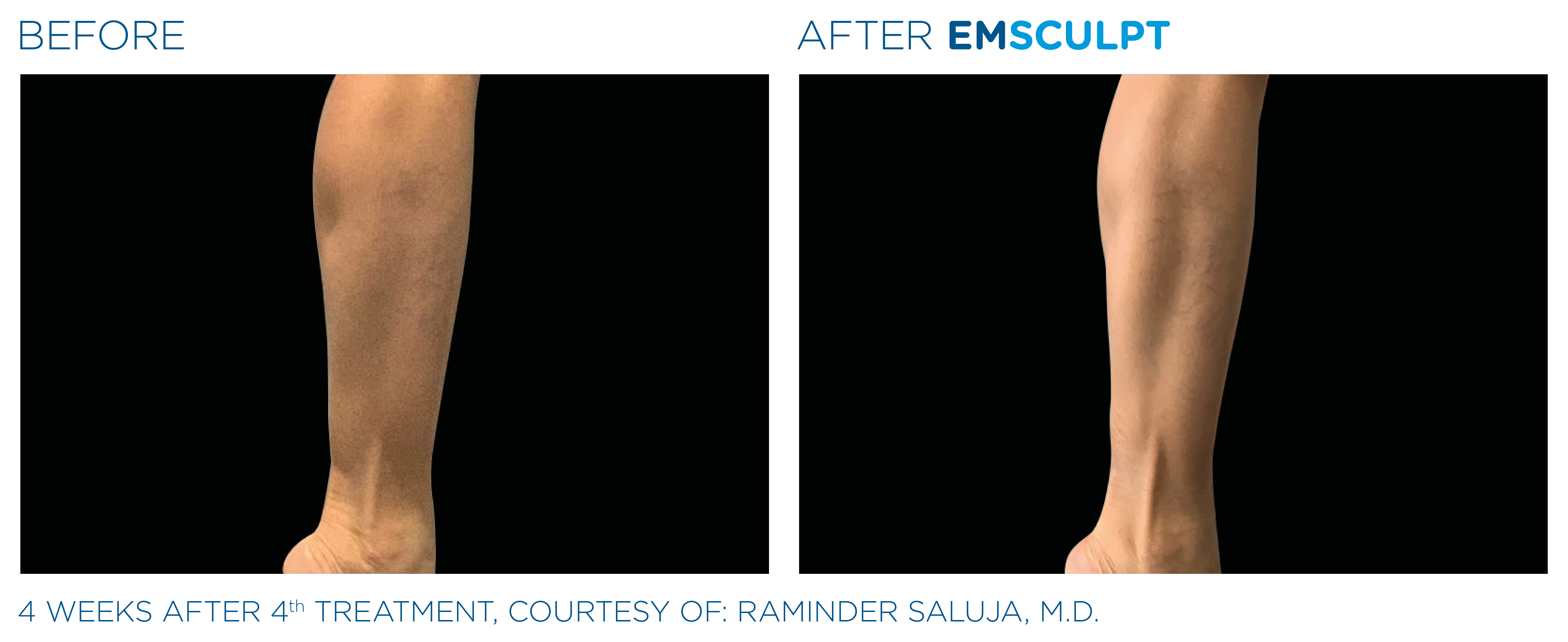 Emsculpt before and after calves — medAge Asheville