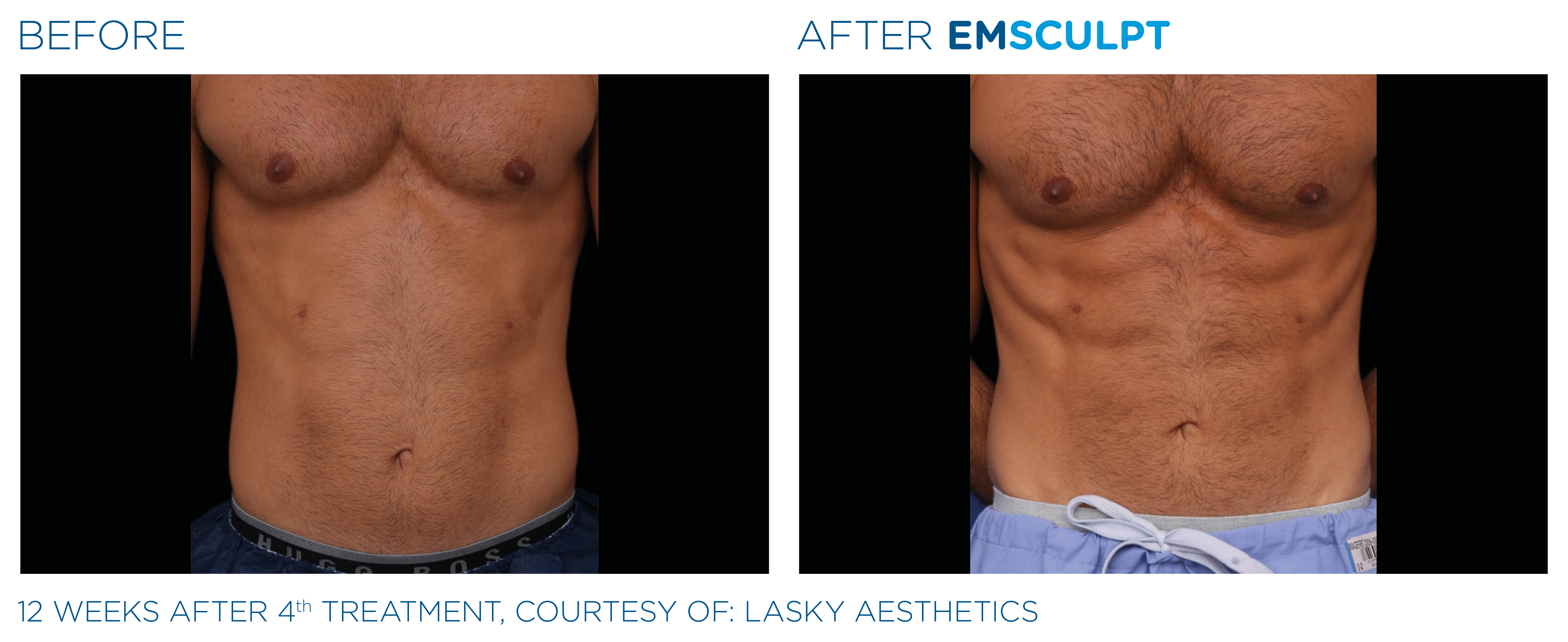 Emsculpt before and after abdomen — medAge Asheville
