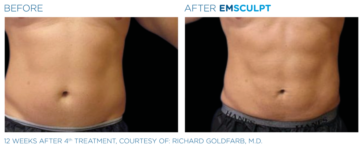 Emsculpt Asheville before and after male abdomen